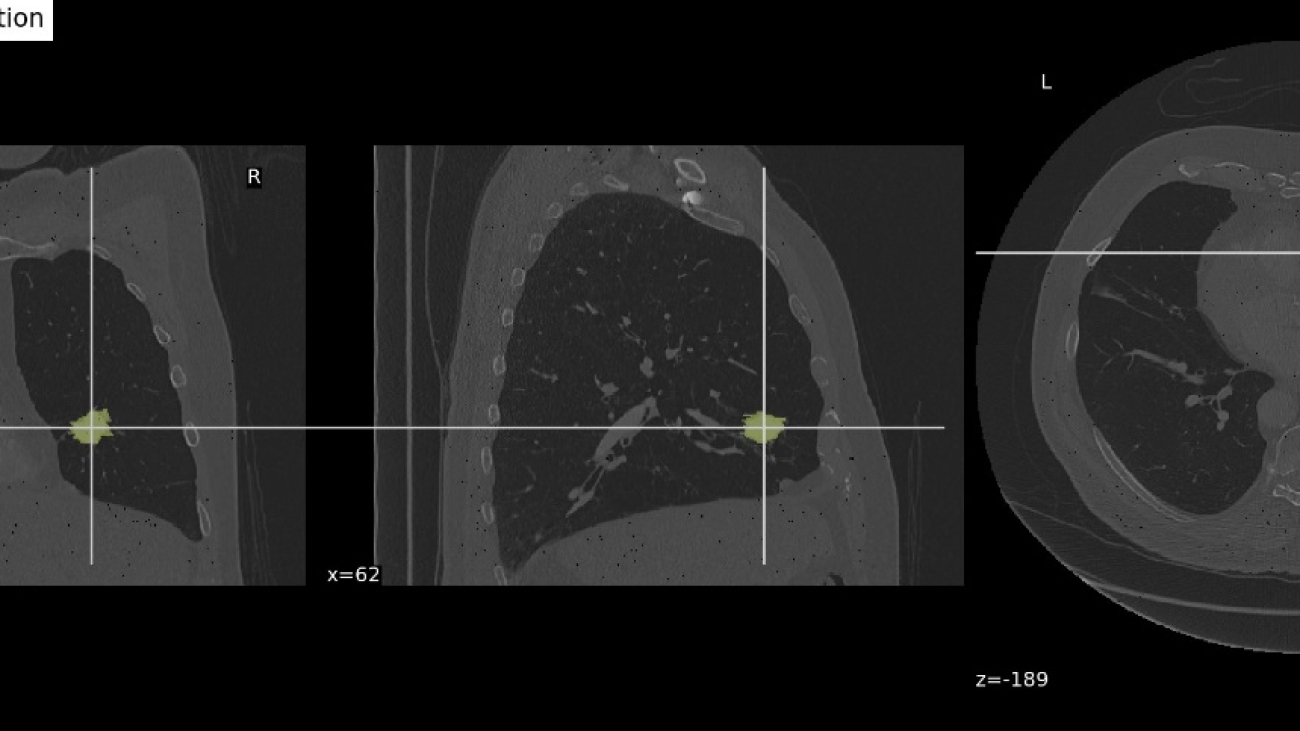 Predict lung cancer survival status using multimodal data on Amazon SageMaker JumpStart