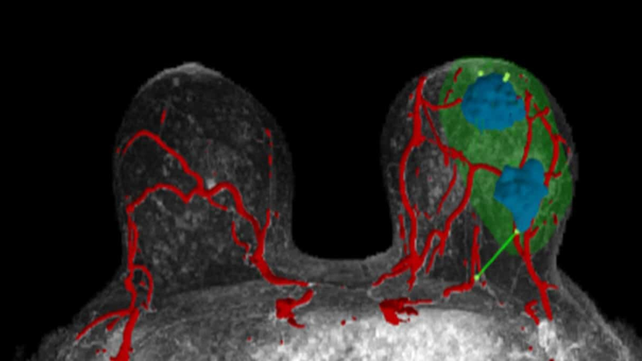 Startup Helps Surgeons Target Breast Cancers With AI-Powered 3D Visualizations